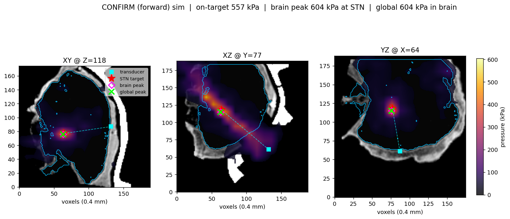 Simulated ultrasound pressure in three planes of a macaque brain, peaking at the subthalamic nucleus target